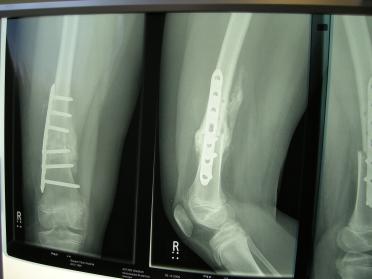 XRays